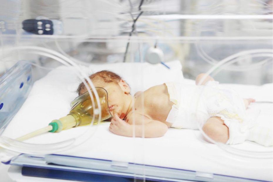 Seorang bayi sedang berada dalam inkubator karena mengidap sindrom Edward.